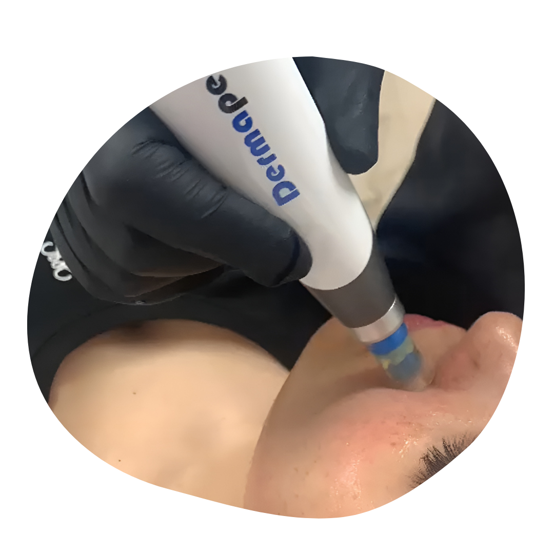 Microneedling Dermapen casablanca
