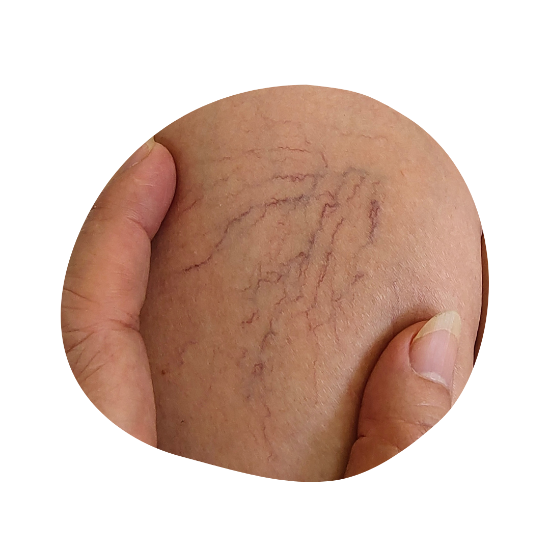 Epilation laser sans douleurs