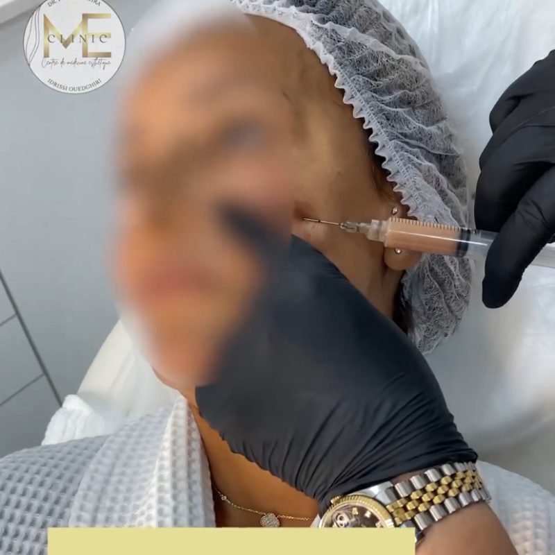 Injections esthétiques Casablanca prp casablanca Meclinic casablanca