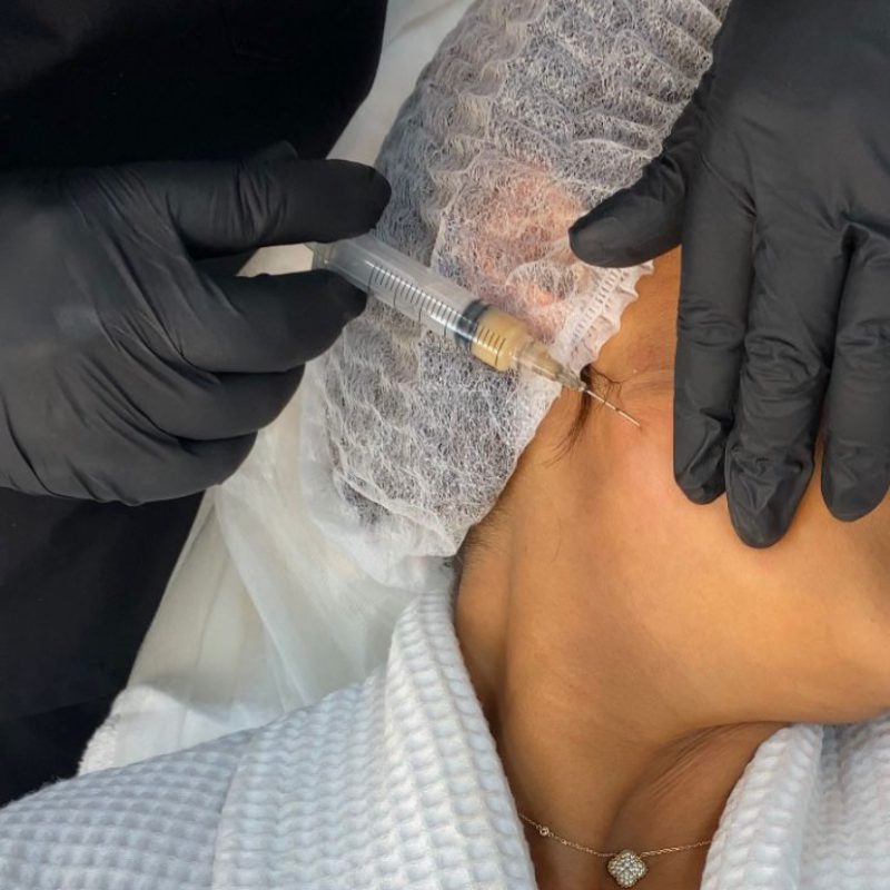 Injections esthétiques Casablanca Iprf casablanca Meclinic casablanca