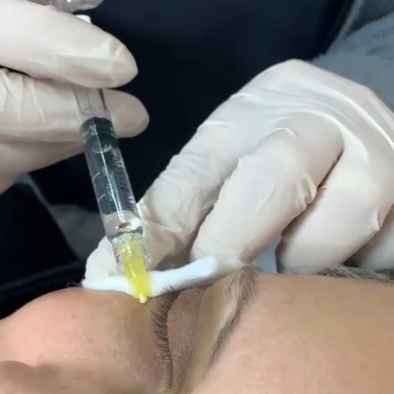 Injections esthétiques Casablanca plural silkcasablanca Meclinic casablanca