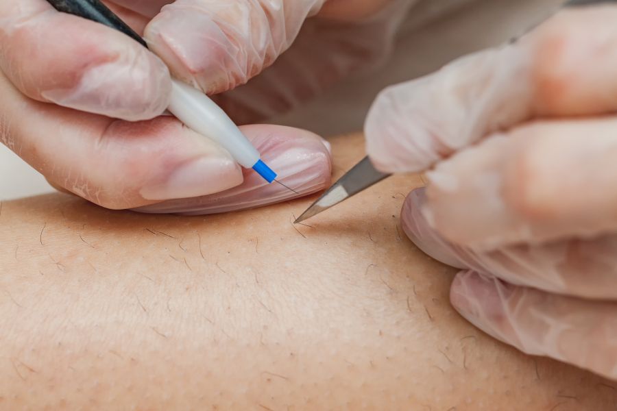 epilation par electrolyse Casablanca