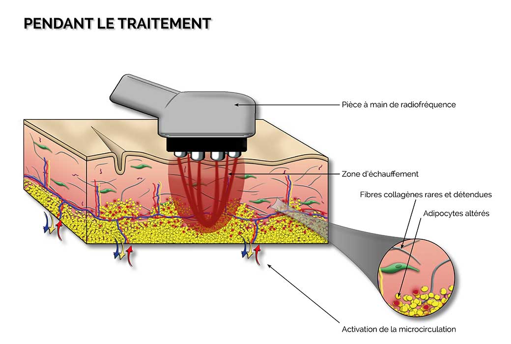 Radiofréquence combinée au Skinbooster