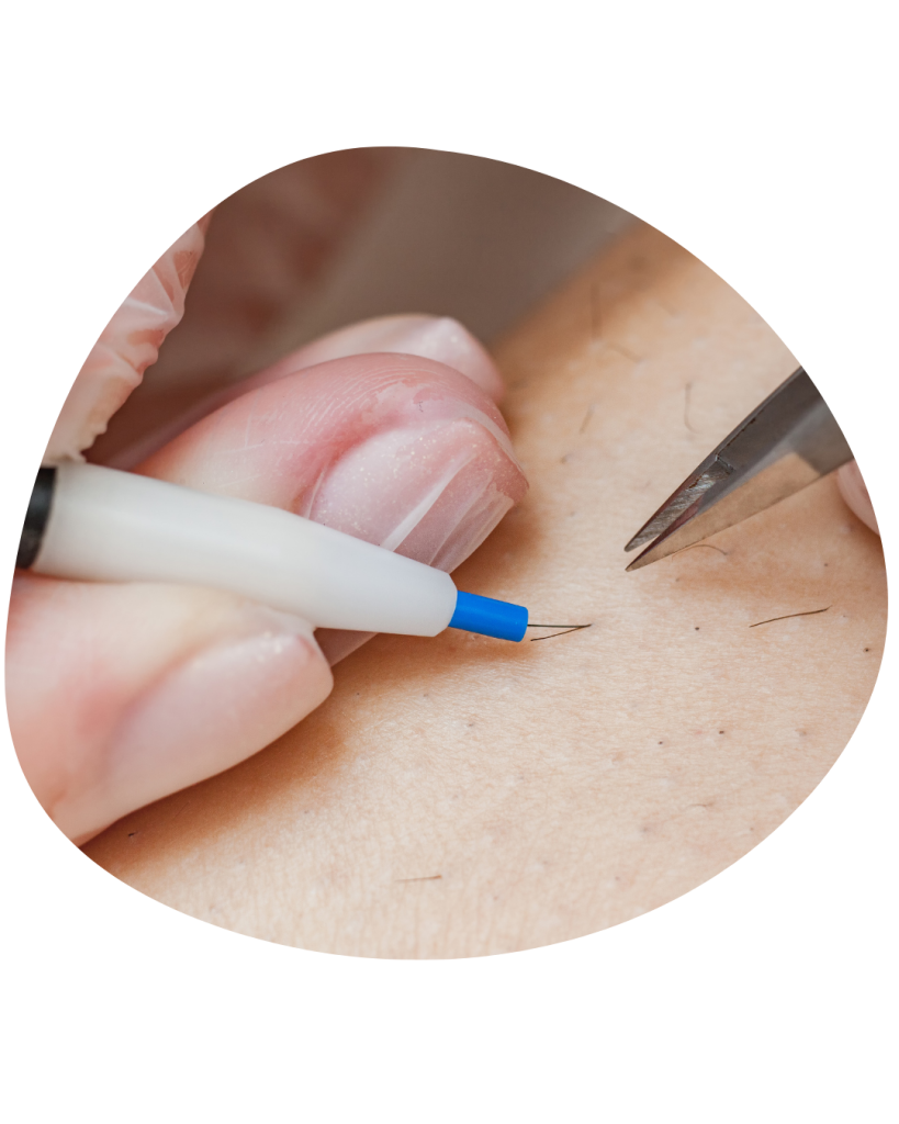 Electrolyse Casablanca -MEclinic