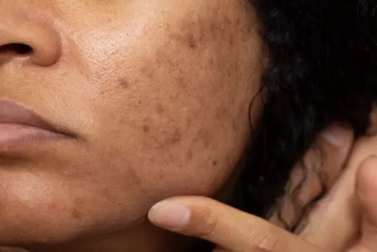 Tâches pigmentaires & melasma - Meclinic