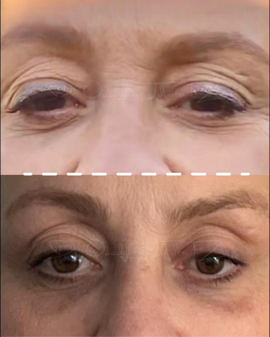 Avant après blépharoplastie au laser CO2