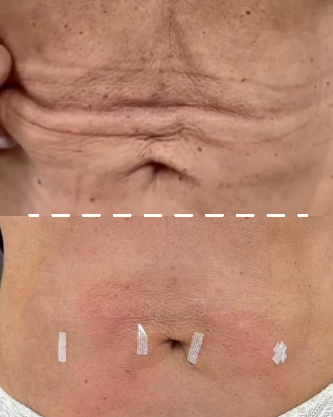 Endolift du ventre : avant et après, patiente Meclinic