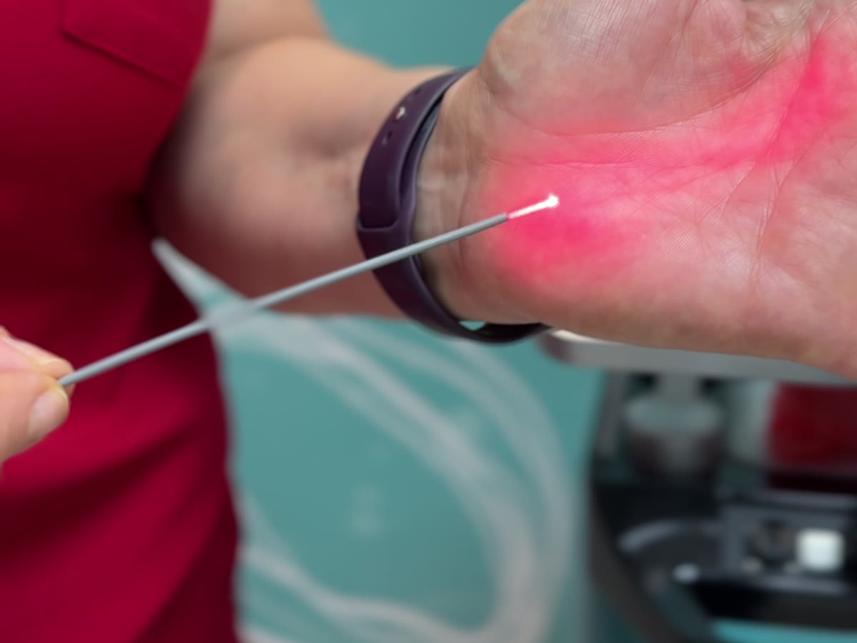 Fibre laser Endolift utilisée au cabinet Meclinic à Casablanca
