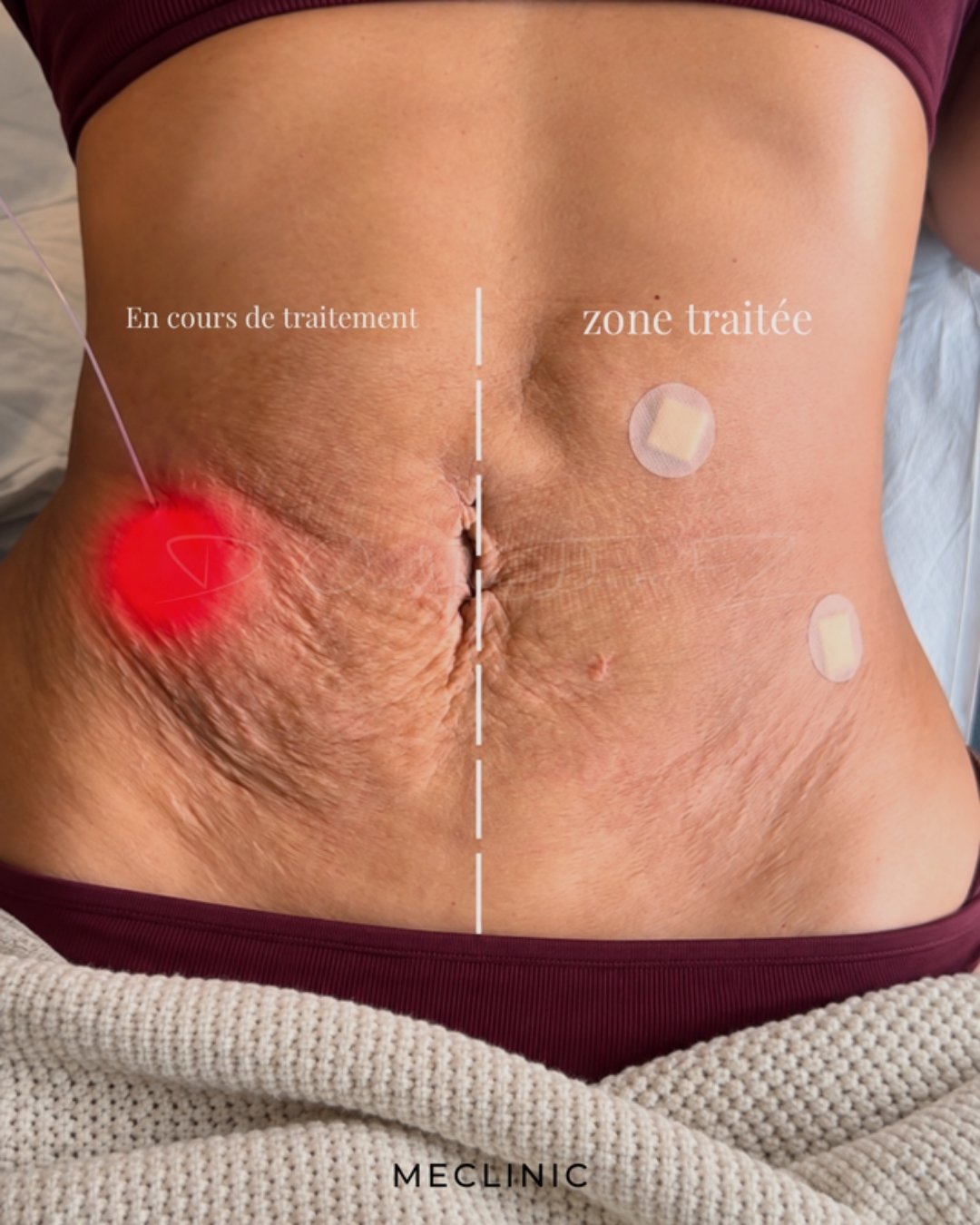 Endolift du ventre en cours de traitement au cabinet Meclinic