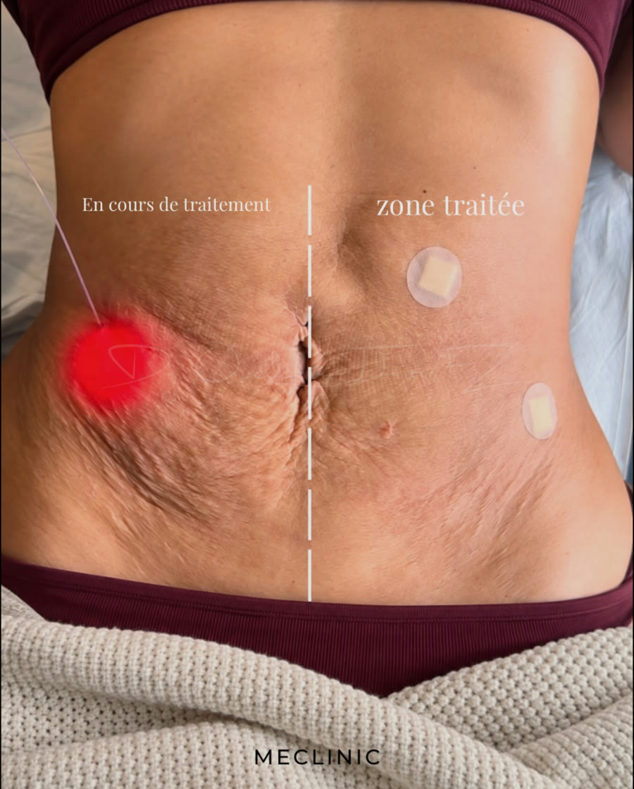 Endolift : zone en cours de traitement et zone traitée